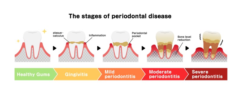 牙周病階段